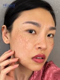 Bóc Trần Sự Thật Về Lăn Kim và Peel Da