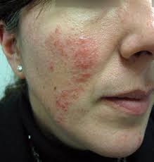 Talk to a dermatologist near you. 5 Things You May Not Know About Rosacea News Releases