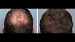 (2) in 2002, the journal of dermatology also published a study which compared the effects of different hair growth in the mice who received ketoconazole was significantly greater than the placebo group. Nizoral For Hair Loss Uphairstyle
