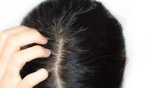 The hair grows back within 12 months or less. Does Scalp Eczema Cause Hair Loss