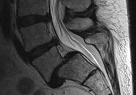 We did not find results for: Spondylolisthesis Wirbelgleiten Mta R De
