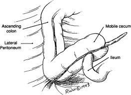 Mobile Cecum | Radiology Reference Article | Radiopaedia.Org