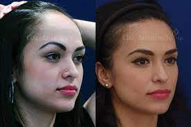 Forehead Reduction Surgery Hairline Lowering Surgery Before And After Photos Forehead Reduction Surgery Forehead Reduction Hair Reduction