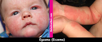 fotograflarla sik rastlanan cocuk hastaliklari 1 bebekveben