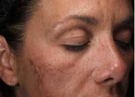 Image result for Melasma calycinum