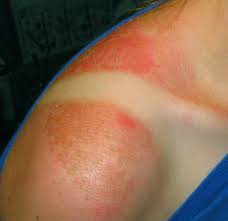Black tea contains an acid that provides soothing effects which help eliminate the excess heat from the sunburn. The Single Most Effective Way To Get Rid Of A Sunburn 3 Steps With Pictures Instructables