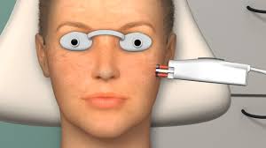 Laser Skin Resurfacing in Orange, CT