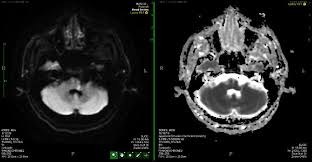 Over the last 15 years, i have. Pontine Infarct Camouflaged As Bell S Palsy Phipps Journal Of Neurology Research