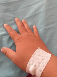 Tangan Bengkak Karena Infus Bagian 2