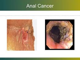 A cancer diagnosis can leave you unable to comprehend anything else your doctor says, but it's important to pay attention to what stage of cancer you have. 755 Mount Vernon Hwy Ne Ste 350 Atlanta Ga Ppt Download