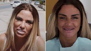 Let's talk about katie prices 'veneers'. Katie Price Horrified As Teeth Fall Out Amid Getaway With Boyfriend Carl Woods Aktuelle Boulevard Nachrichten Und Fotogalerien Zu Stars Sternchen