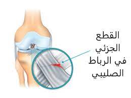 القطع الجزئي للرباط الصليبي الأمامي - عيادة الركبة و الفخذ