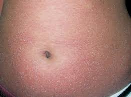 Image result for Generalized Rash