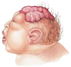 Then, it needs to find the right location where it can survive, and reproduce. Anencephaly Abnormal Development Of Brain And Skull