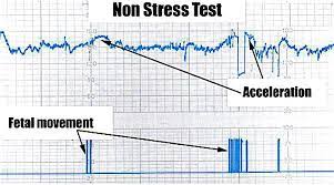 Nitroblue tetrazolium test in children with fatal granulomatous disease and newborn infants / park b.h. Non Stress Test Nst Babymed Com