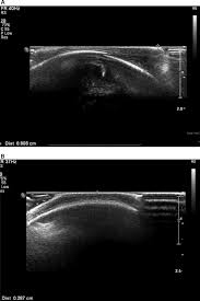 Image result for Cephalhematoma