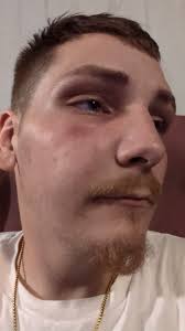 For 2 days my face was swollen due to abscess or a gum infection, Mrs  Kelley Saxon told me about a garlic remedy only I can't suck