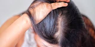 Hair loss caused by iron deficiency looks exactly the same as hormonal hair loss, meaning you'll usually notice hair falling out around the middle of your head, the crown and the hairline. How To Treat Hair Loss With Diet And Supplements The Guerrilla Diet