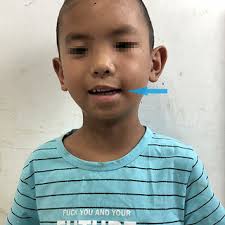 PDF) Analysis of a Case of Facial Nerve Injury Caused by Bee Sting in a  Child