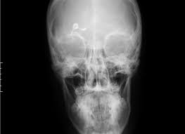 Vp Shunt Disconnection Radiology Case Radiopaedia Org