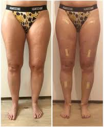 Zentrum Fur Lipodem Diagnose Und Therapie Dr Barsch