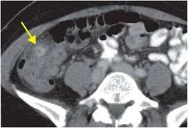 Although these findings can be mistaken for ulcerative colitis or crohn's disease. Lower Quadrant Pain Section 1 3 Emergency Radiology Coffee Case Book