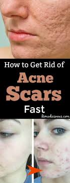 Now apply this paste onto your acnes. How To Get Rid Of Acne Scars Fast 9 Best Home Remedies