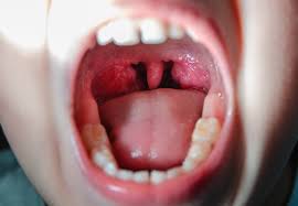 Image result for Tonsillitis