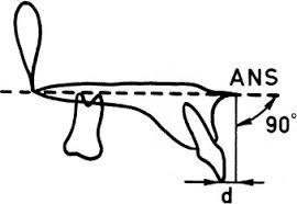 Herren—overextends in saggital plane 10 to 15mm beyond postural rest. References In A Modified Teuscher Activator Seminars In Orthodontics