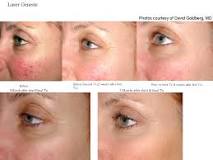 Image result for what is genesis skin treatment