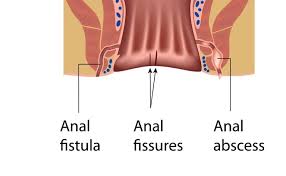 Image result for anal fistula