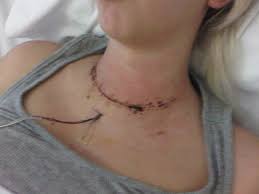 Thyroid Surgery Thyroid Surgery Thyroidectomy Thyroid Surgery Scar