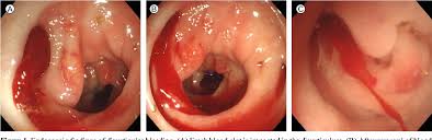 Image result for Diverticular Bleeding