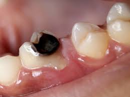 Los signos y síntomas de las caries varían, según el tamaño y la ubicación. Carie Dentaire Dentiste Drancy