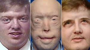 He suffered devastating burns when he tried to rescue a woman trapped in a  fire. For years, he was terrified to show his face to the world, and wore  caps, sunglasses and