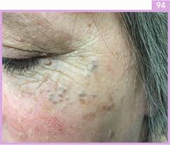 Is a form of sun damage. Favre Racouchot Plastic Surgery Key