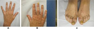 Image result for Yellow nail syndrome feet