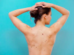 With pets living longer than ever, cancer has become a diagnosis that we see more commonly in older dogs. 10 Signs Of Skin Cancer You Shouldn T Ignore Self
