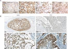 Other types of bone cancer include fibrosarcoma( malignant giant cell tumor) and chordoma. Higher Cmet Dependence Of Sacral Compared To Clival Chordoma Cells Contributing To A Better Understanding Of Cmet In Chordoma Scientific Reports