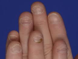 If it is not controlled on tym its hard to stop bitting it. Onychophagia Dermnet Nz