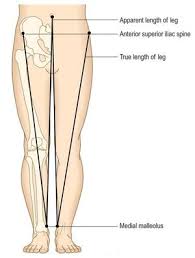Image result for Functional Leg Length Discrepancy