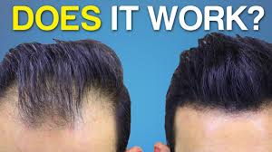 Genetic hair loss however, is a progressive condition so it is important that you consider the use of fda approved hair loss drugs such as propecia (finasteride) and rogaine 5% (minoxidil) to fight against future hair loss. Does Hair Fiber Spray Work Better Hair Coverage Youtube