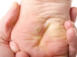 This is because they're highly vascular, setting them apart from other skin conditions. Wart Verruca Surgery Perform Podiatry