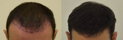 ❓quiz tricologico quale tra questi famosi cantanti si è sottoposto ad un autotrapianto di #capelli? 5 Fattori Da Considerare Prima Di Fare Un Trapianto Di Capelli