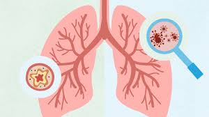 Image result for Pneumonia