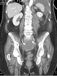 This mri male pelvis axial cross sectional anatomy tool is absolutely free to use. Active Bleed In Left Psoas Muscle And In The Left Upper Quadrant And Pelvis Gastrointestinal Case Studies Ctisus Ct Scanning