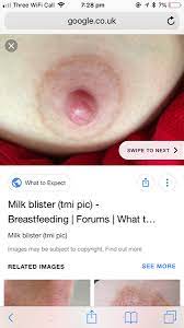 In addition, the mother can also massage with fingers, from the edge of the breast toward the nipple. Milk Bleb Blister Mumsnet