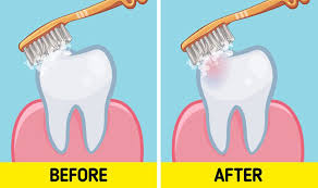 Nạo túi quanh răng ở mặt xa của răng sau cùng
