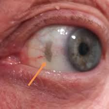 Image result for lesion sclera