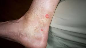 Check spelling or type a new query. What Bit Me How To Identify Common Bug Bites Everyday Health